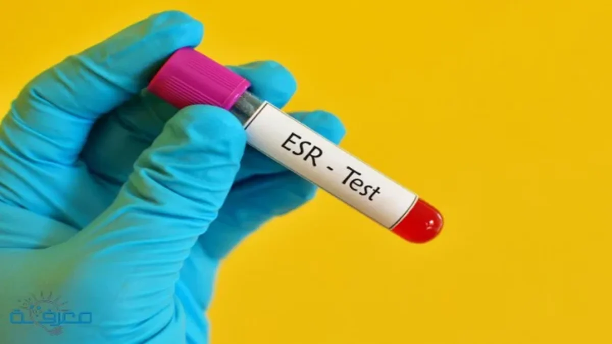 نتائج تحليل ESR