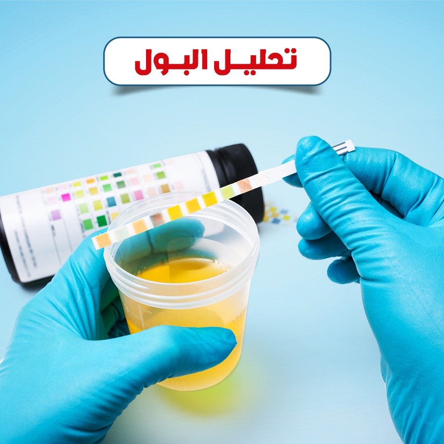 تحليل البول
